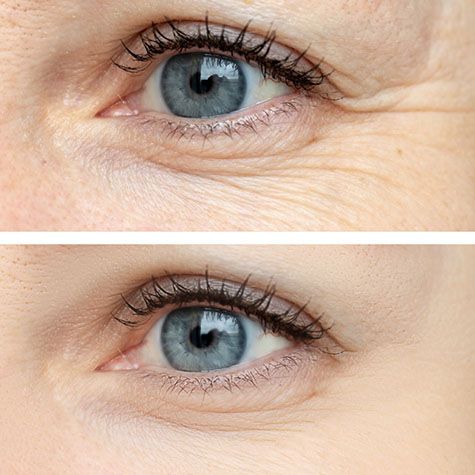 before and after of good candidate for BOTOX