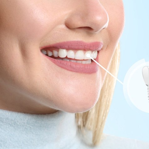 woman smiling with dental implant in mouth